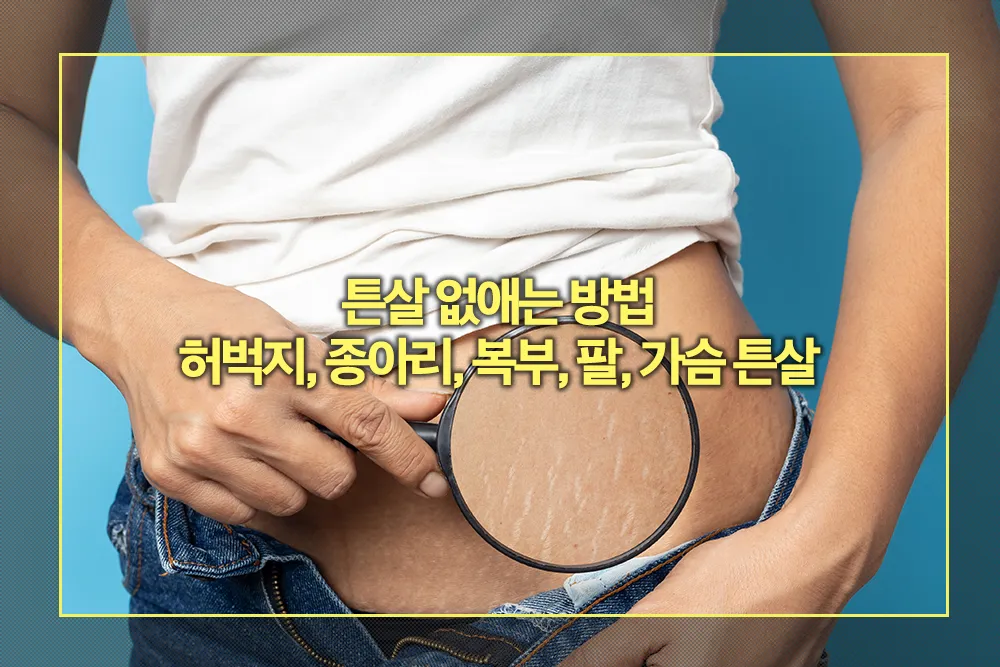 튼살 없애는 방법 허벅지, 종아리, 복부, 팔, 가슴 튼살