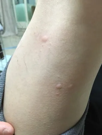 모기 물려 가려울 때 땀띠에 안티푸라민 연고 효능 부작용 사용후기_4