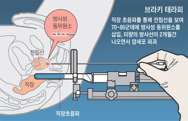 전립선암 초기증상