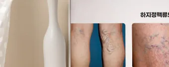 하지 정맥류 증상 치료방법과 예방 생활습관_21