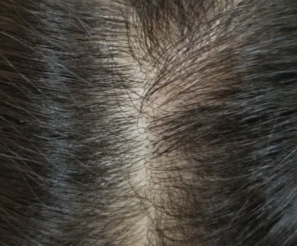 모발이식 3000모 비용 4000모 비용 부작용 과정