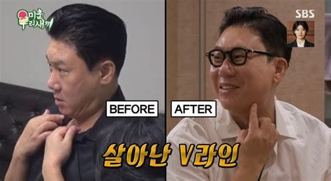 지방흡입술가격