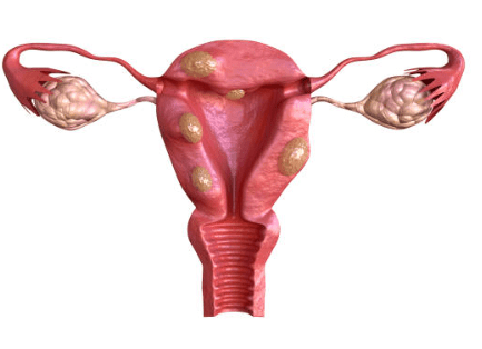 자궁근종 증상 7가지, 수술후 회복기간
