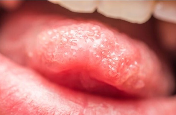 혓바늘 자주 묻는 질문 FAQ