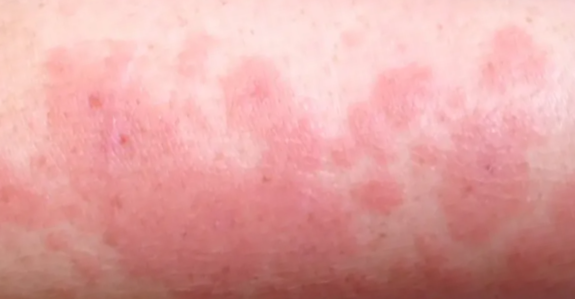 햇빛 알레르기 정의