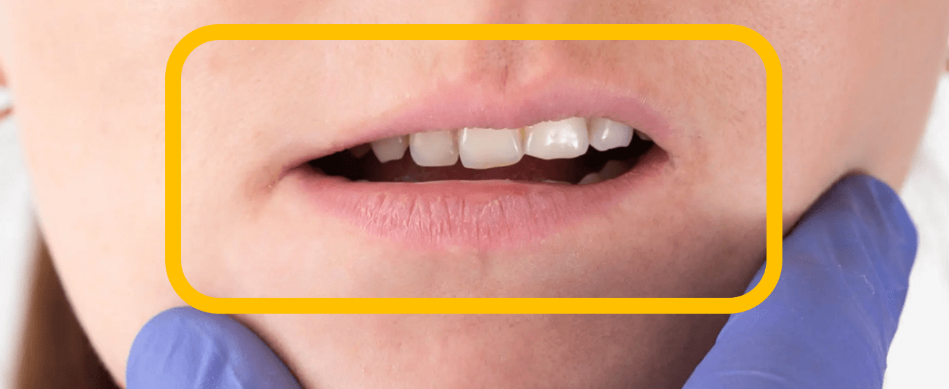 과개교합-치료-안하면