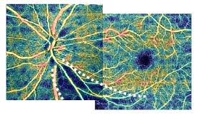 녹내장 초기증상 원인 치료방법