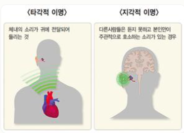 이명 증상 원인 치료방법