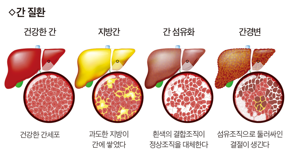 다양한 간 질환을 묘사한 그림