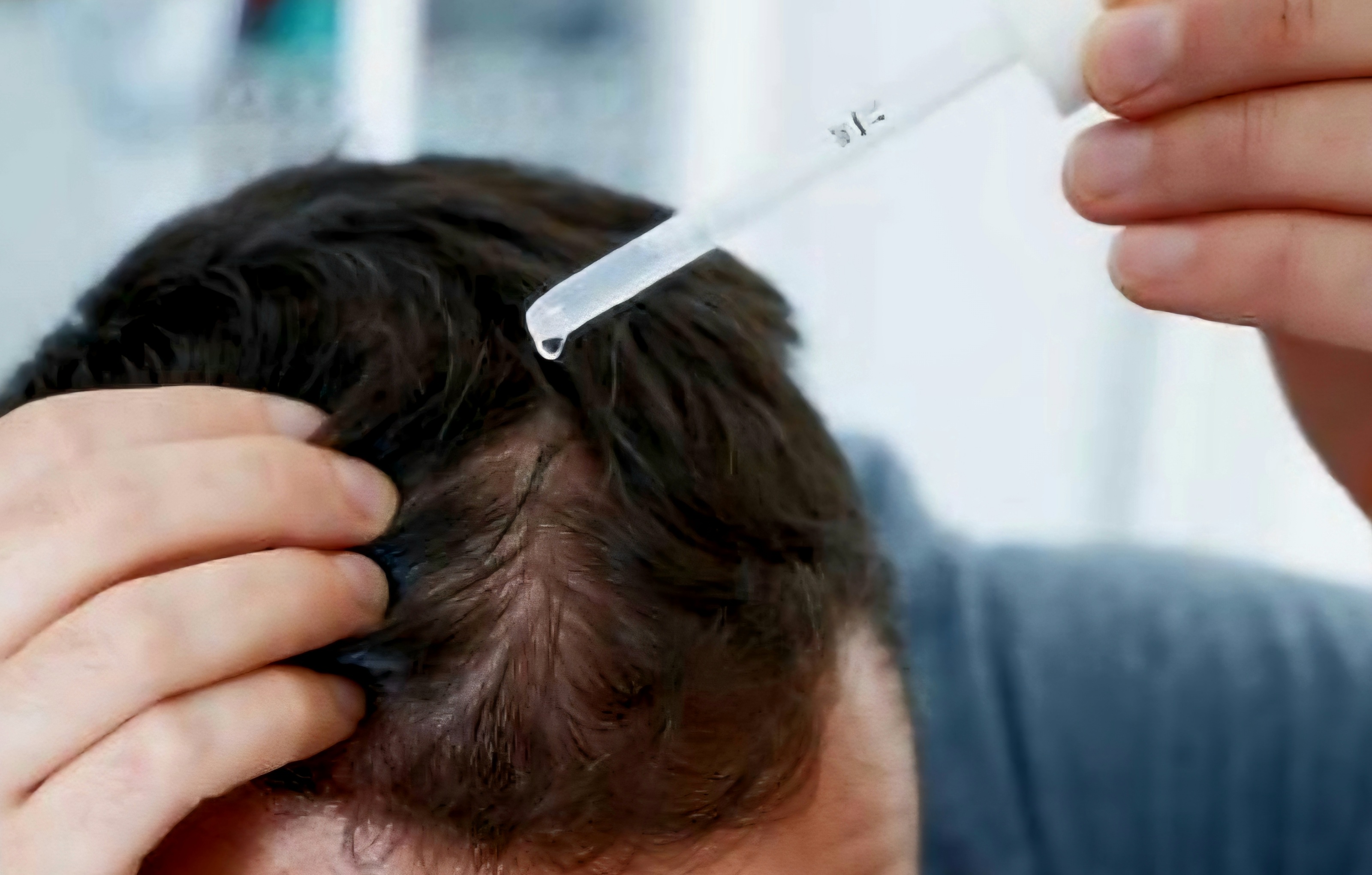 남자가-탈모약을-머리에-뿌리고-있다