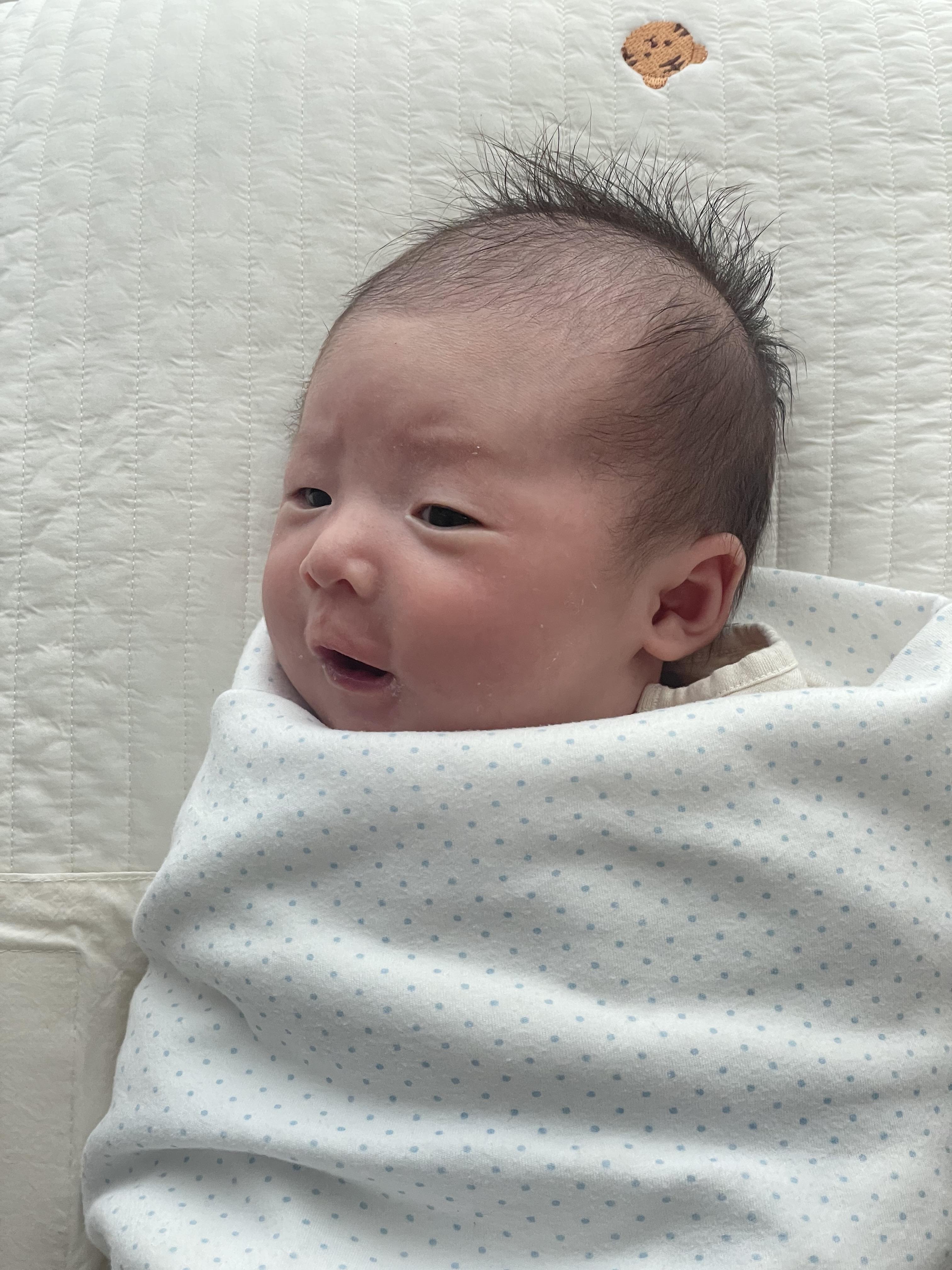 혈관종 에스앤유 피부과