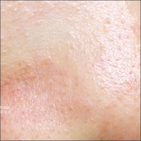 모공 피지 제거 후