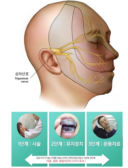 삼차 신경통의 신경외과적 치료