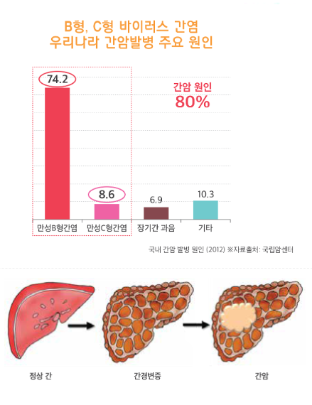 간암 초기증상 (1기~4기, 말기까지 증상 총정리)