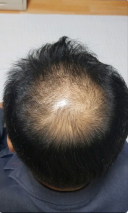 탈모지원금-설명사진