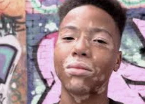 백반증 초기증상 29