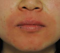 지루성 피부염 완치하려면