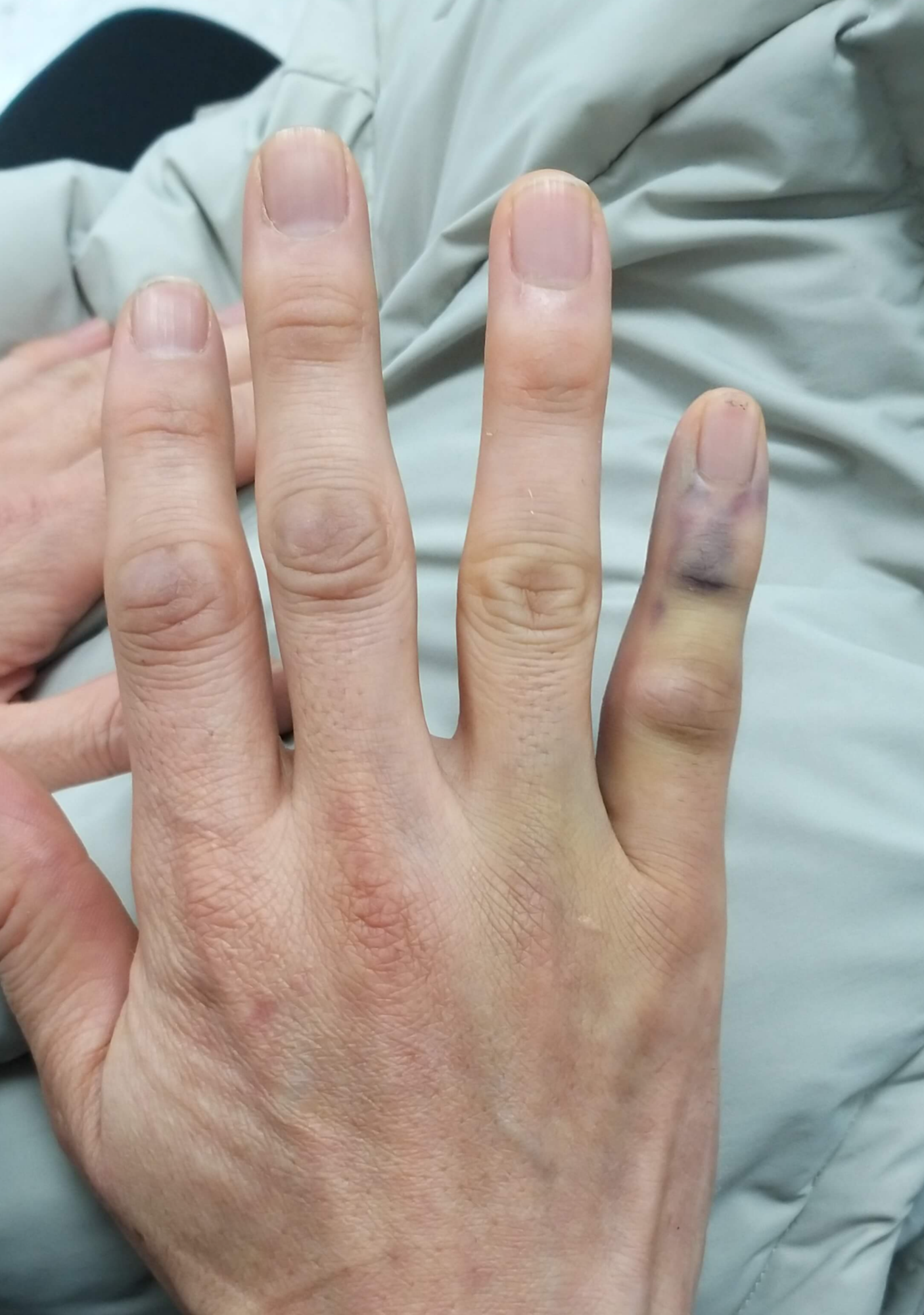 처음병원간날손가락사진2