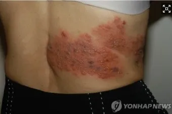 경기도 대상포진 무료접종 연령 기준 정리로 안내_11