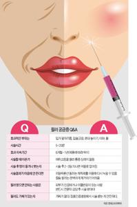 미간필러