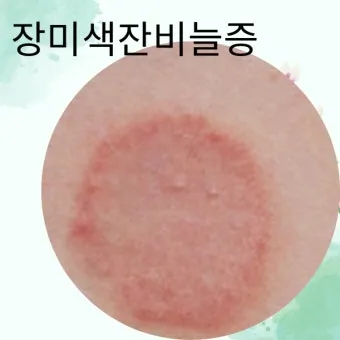 얼굴 버짐 증상 없애는 실전 방법 5가지 및 관리요령_10