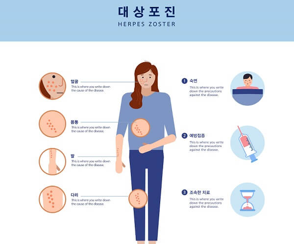 대상포진 발생 경과 초기 증상