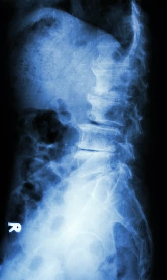척추 전방전위증(Spondylolisthesis): 원인, 증상, 치료 및 예방법