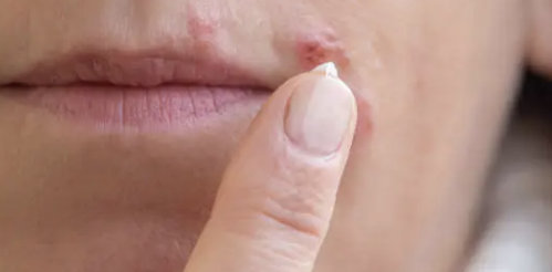입술에 물집이 생기는 이유 13