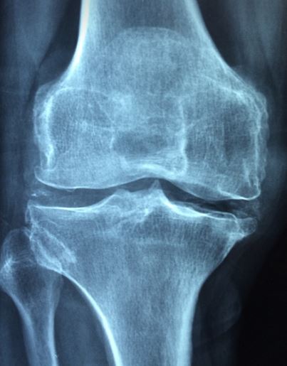 무릎줄기세포주사 가격 및 무릎줄기세포주사 실비 실손 보상 / 전국 병원추천