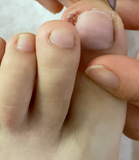 라셀턴 발톱세럼, 거품 나오는 문제성 무좀 발톱 치료 의약외품 2주 써봤다