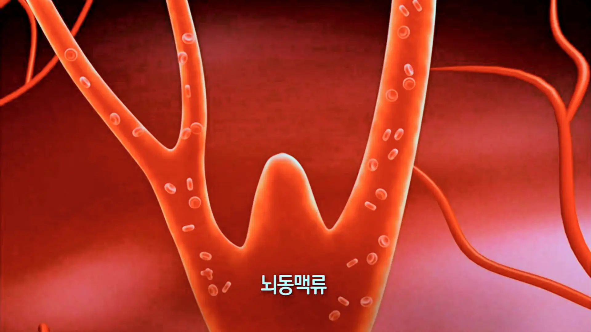 KBS 생로병사의 비밀 835회 뇌졸중 치료, 후유증, 뇌동맥류 검사 예방법 방법 오늘방송 다시보기 정보