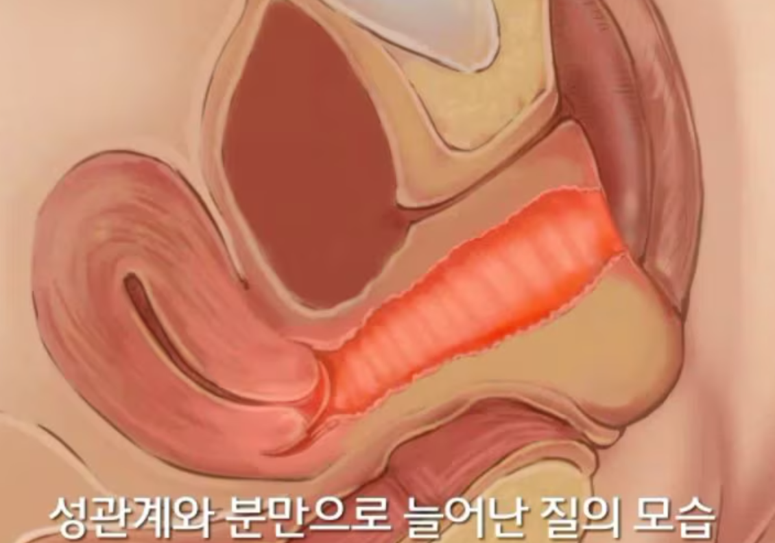 질이완증 / 질 이완 증상, 노화일까? / 질이완증 체크리스트 / 방치하면 생기는 문제와 해결 방법