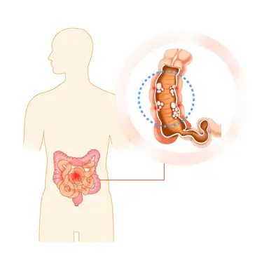 실리악병-원인-글루텐