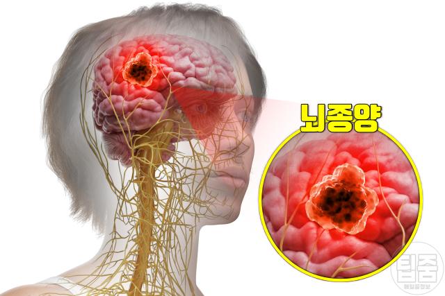 뇌종양 증상 초기증상