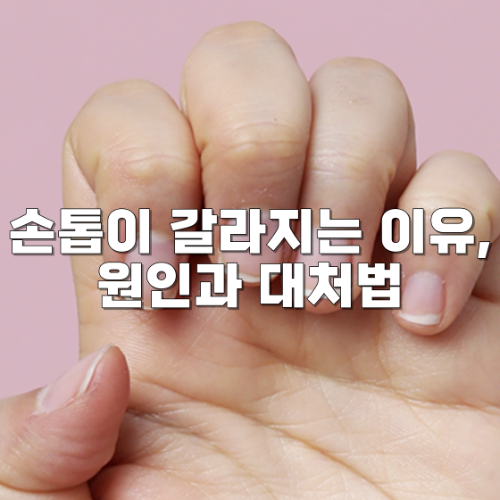 손톱이 갈라지는 이유, 원인과 대처법