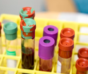 간경변증 치료방법 진단기준 합병증