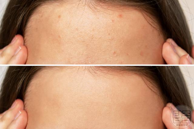 호두 효능 이마 여드름,호두 하루 섭취량