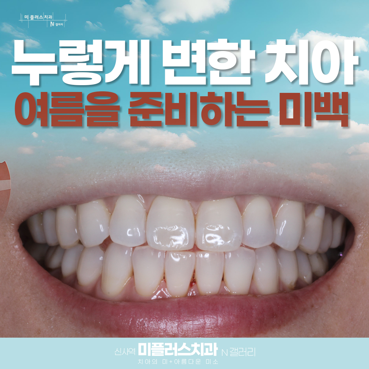 치아미백 시술 전 누렇게 변색된 치아 상태