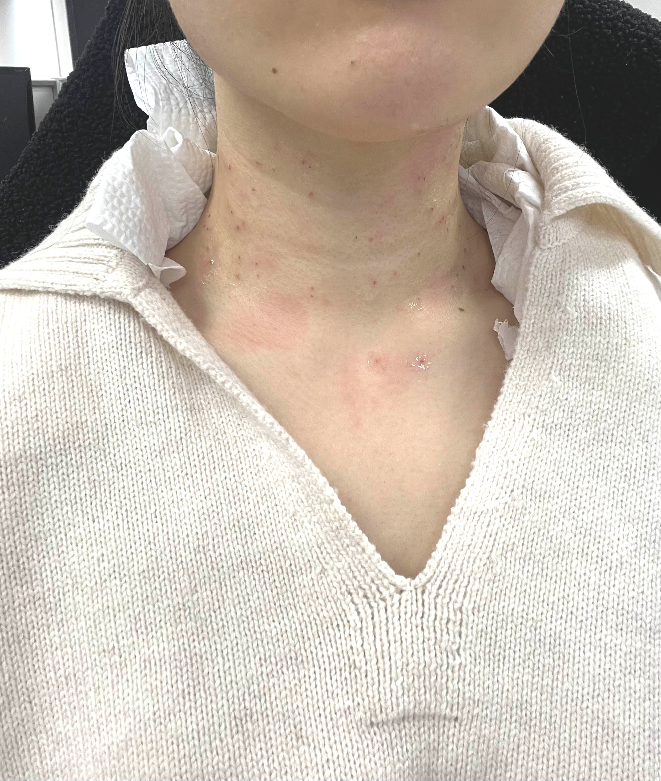 편평사마귀 제거 관리 후기