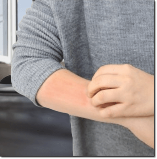 알레르기 생긴 남성