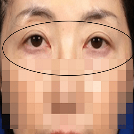 실리프팅 시술을 받기 전 여성의 모습 사진