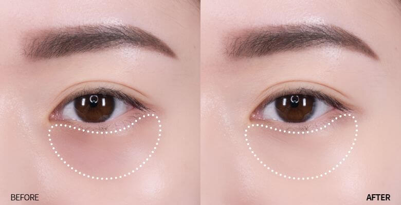 다크서클-초기에는-마사지-피부관리로-치료가능