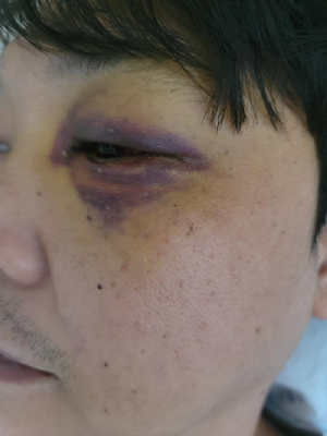 A씨의 폭행당한 얼굴 사진 [사진=보배드림 캡쳐]