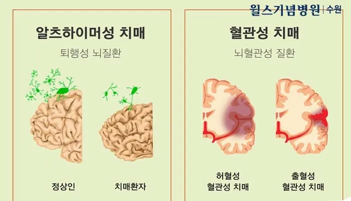 혈관성치매 원인 증상 치료법과 예방 생활습관_1