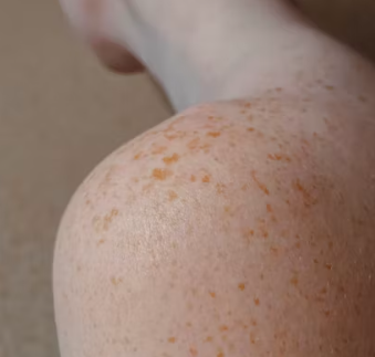 피부질환 종류 연고 종류 이유