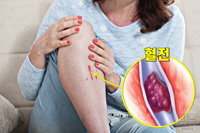 흑염소 효능 부작용 염소탕 효능 혈관 혈전