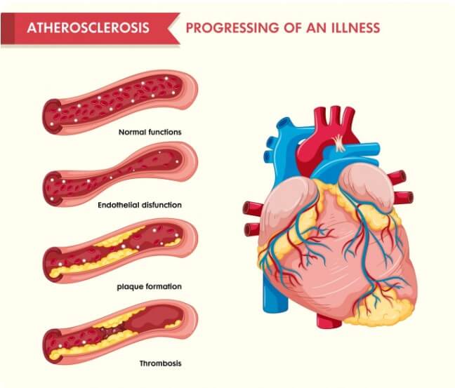 혈관 속 노폐물의 정도