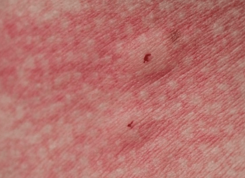 빈대 물린 자국 사진 및 증상