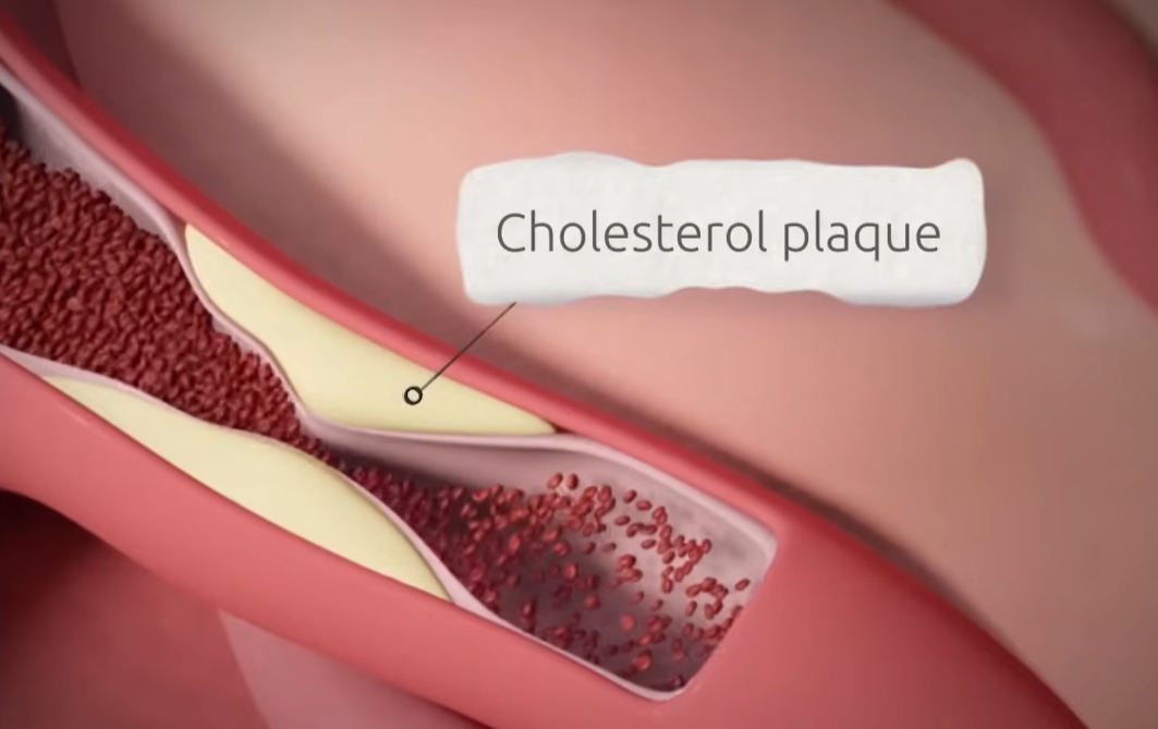 관상동맥 조영술