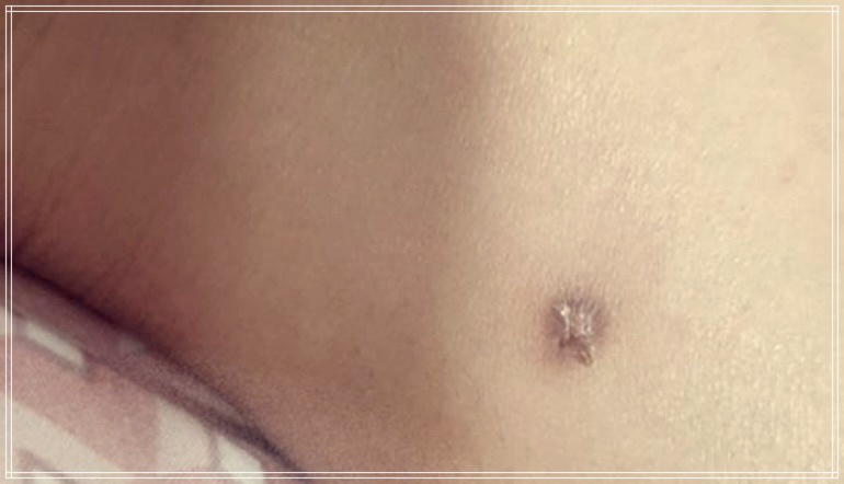 양성 종양과 악성 종양의 차이점